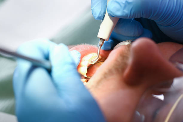 Best Emergency Root Canal Treatment in Earlysville, VA